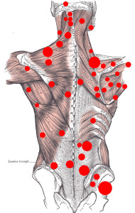 Fig409BackMusclesTrP