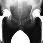 Artroprotesi ed Endoprotesi d’Anca: dall’impianto alla riabilitazione