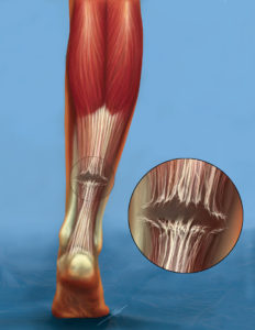 rottura tendine achille
